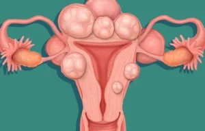 هل يتحول الورم الليفي في الرحم إلى سرطان عند هؤلاء السيدات؟ الإجابة المباشرة هي أن ذلك نادر جدًا