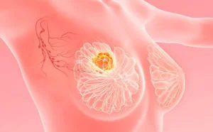 الباً ما تظهر أعراض سرطان الثدي الخبيث مع تطور مراحل السرطان
