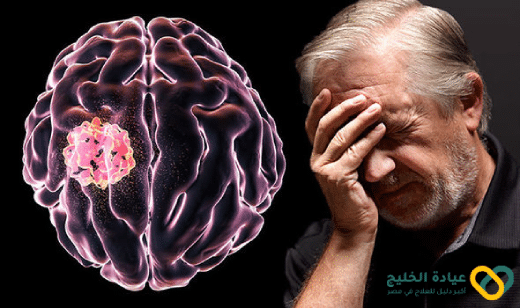 أعراض ورم المخ بالتفصيل