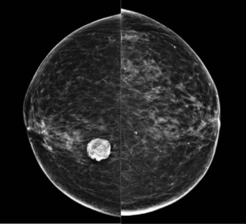 الماموجرام لتشخيص الورم الليفي في الثدي
