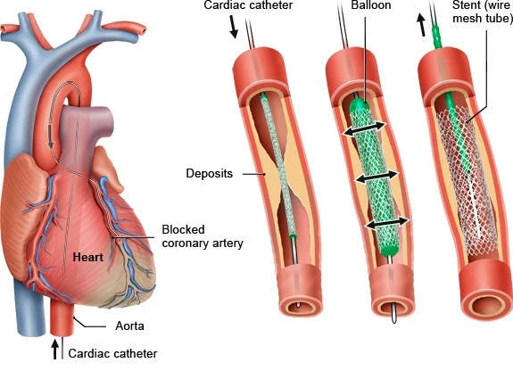 كيفية عمل قسطرة القلب