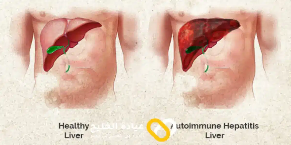 أعراض التهاب الكبد باختلاف أنواعه