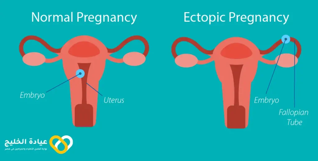 نزول الحمل خارج الرحم