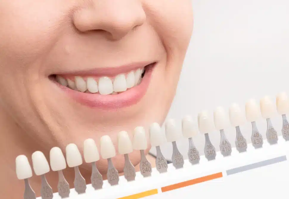 ما هي أنواع تبييض الأسنان واسعارها وافضلها؟